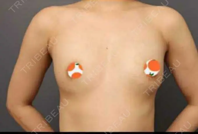 豊胸（脂肪注入） THE CLINIC（ザ・クリニック） 東京院 DAY 98 メイン用