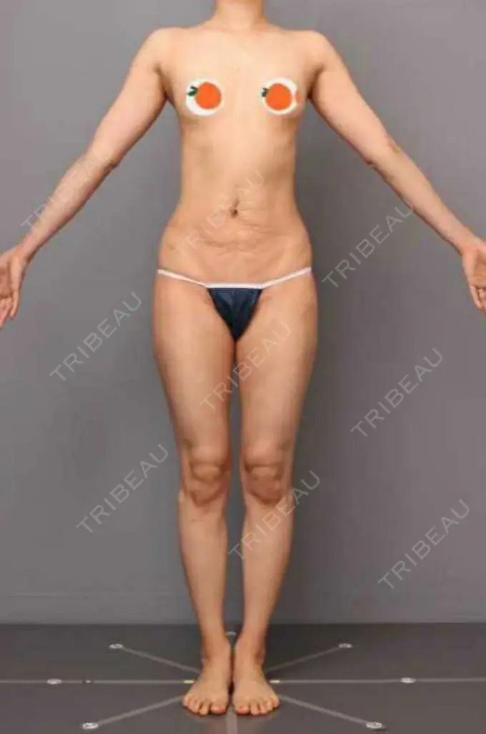 豊胸（脂肪注入） THE CLINIC（ザ・クリニック） 東京院 DAY 98 メイン用