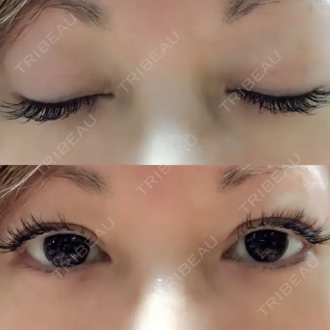 二重埋没 湘南美容クリニック 東京蒲田院 DAY 21 メイン用