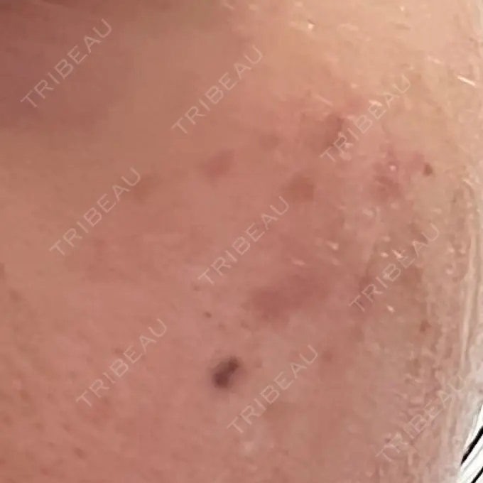 ピコスポット LOUIS CLINIC 二子玉川院【ルイクリニック】 DAY 11 メイン用