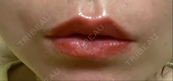 アートメイク（唇） LEAGRANT CLINIC 中目黒 DAY 1 メイン用