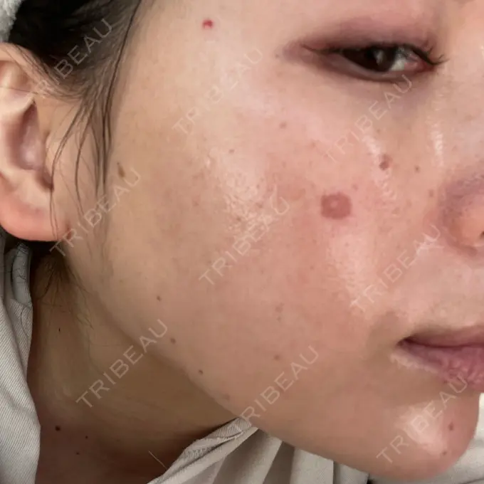 ピコスポット UB CLINIC立川 DAY 5 メイン用