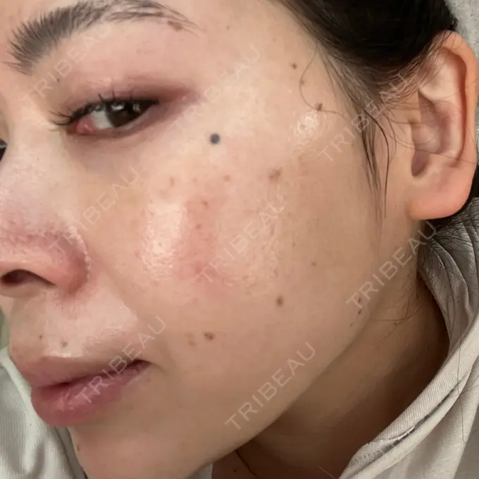 ピコスポット UB CLINIC立川 DAY 5 メイン用