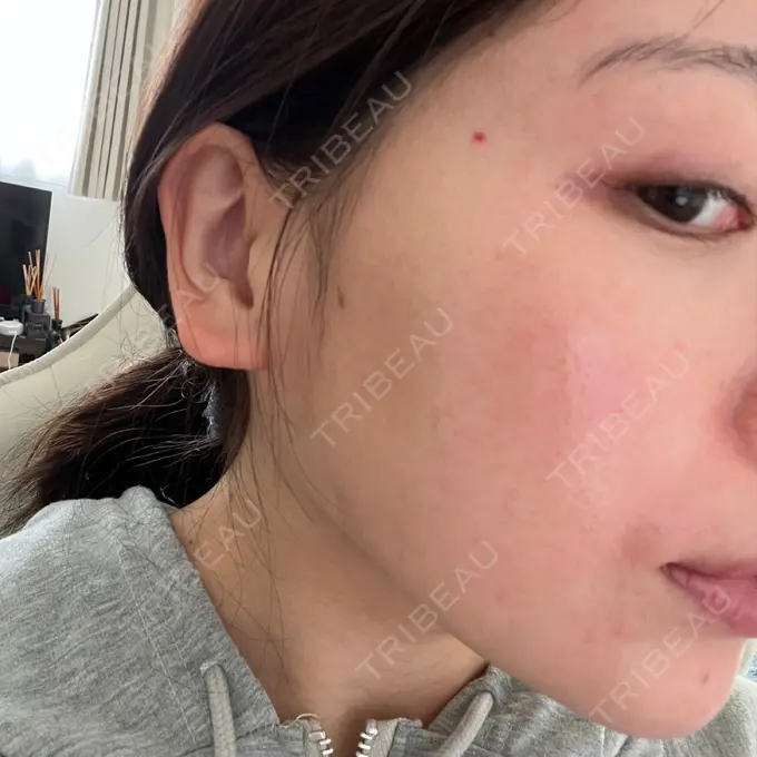 ピコスポット UB CLINIC立川 DAY 14 メイン用