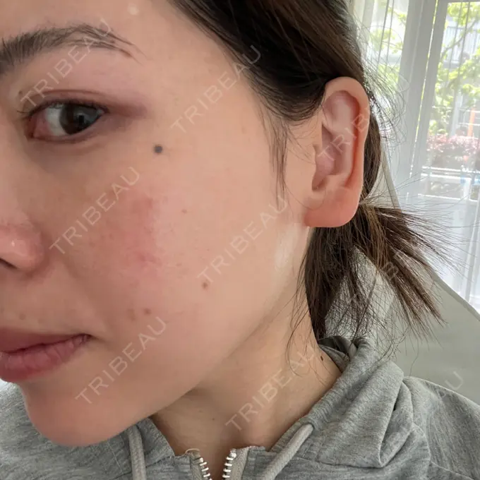 ピコスポット UB CLINIC立川 DAY 14 メイン用