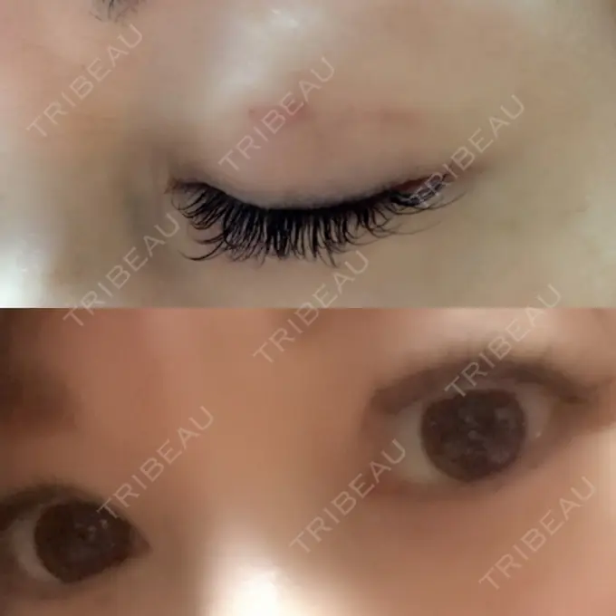 二重埋没 湘南美容クリニック 東京蒲田院 DAY 21 メイン用