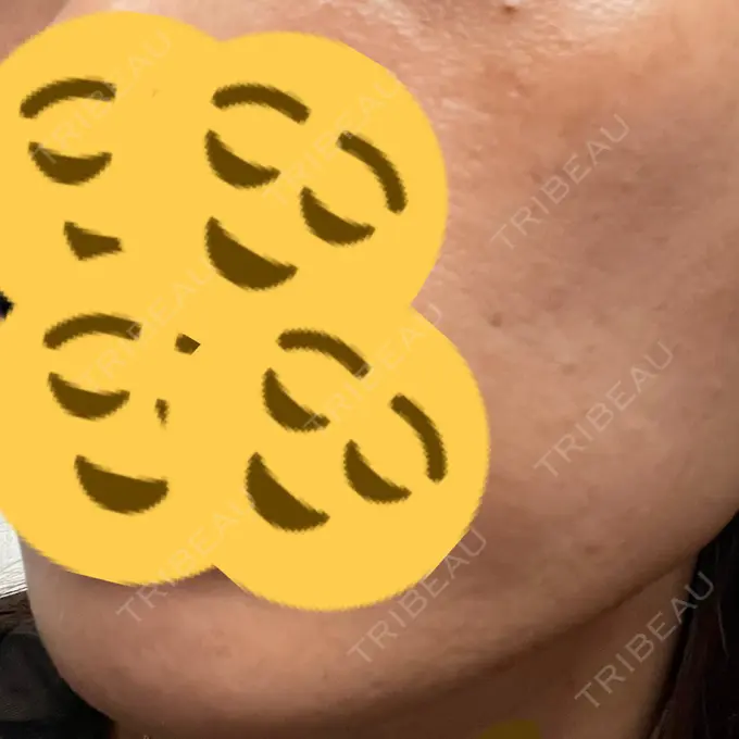 ピコレーザートーニング（美白・肝斑） / ピコフラクショナルレーザー（毛穴・ニキビ跡） ルラ美容クリニック 高田馬場院 DAY 1 メイン用