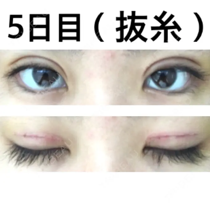 二重切開 みずほクリニック DAY 5 メイン用