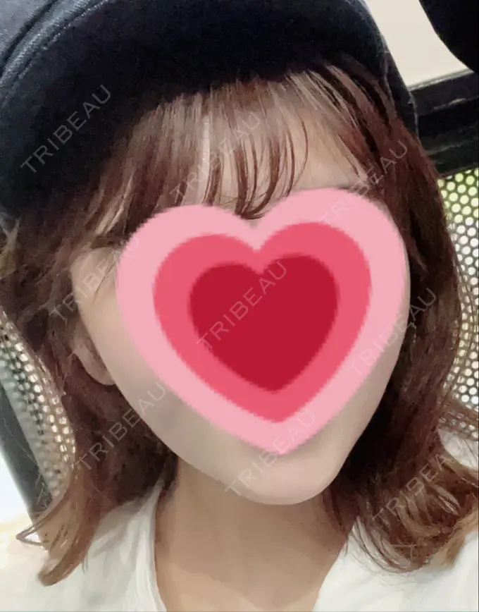 脂肪吸引（顔） / ジョールファット除去 / ボトックス（エラ・小顔） Otus Clinic 【オータスクリニック】 DAY 87 メイン用