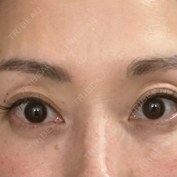 クマ治療 セオリークリニック DAY 96 メイン用