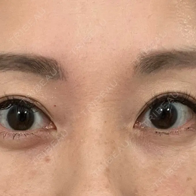 クマ治療 セオリークリニック DAY 35 メイン用