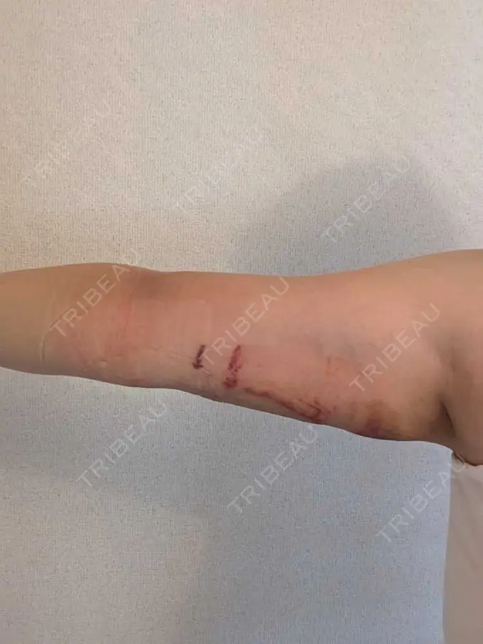 脂肪吸引（二の腕） 石倉クリニック 水戸院 DAY 2 メイン用