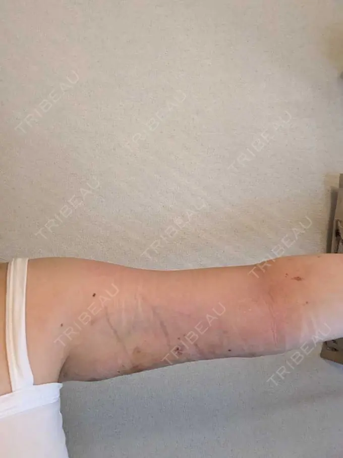 脂肪吸引（二の腕） 石倉クリニック 水戸院 DAY 2 メイン用