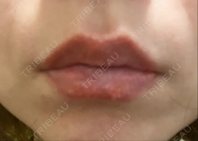 アートメイク（唇） LEAGRANT CLINIC 中目黒 DAY 4 メイン用