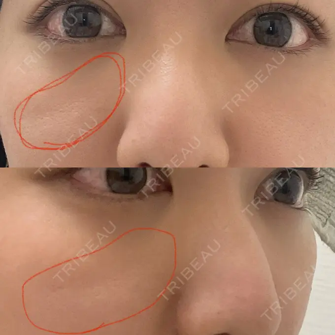 クマ治療 吉井クリニック DAY 40 メイン用