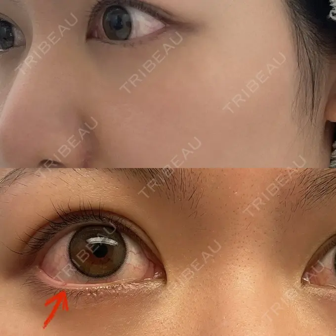 クマ治療 吉井クリニック DAY 40 メイン用