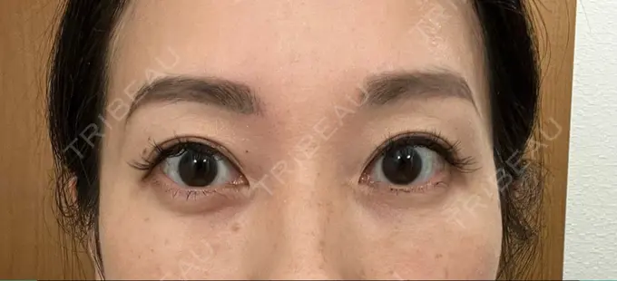 クマ治療 セオリークリニック DAY 35 メイン用