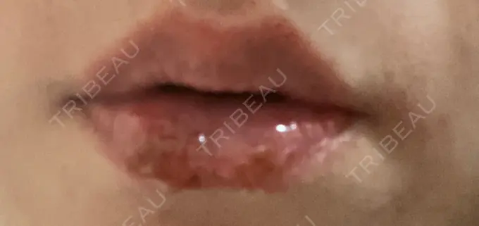 アートメイク（唇） LEAGRANT CLINIC 中目黒 DAY 5 メイン用