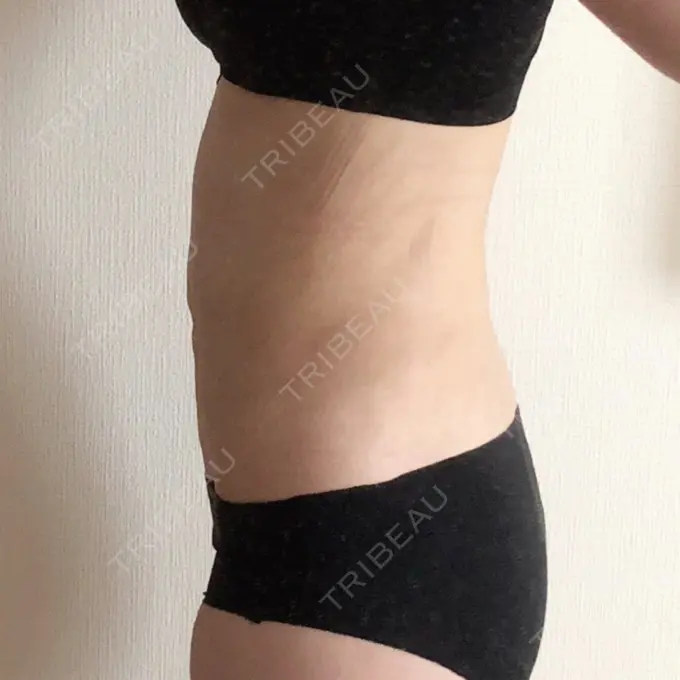 脂肪吸引（お腹） / 脂肪吸引（腰） GAYA body design clinic DAY 21 メイン用