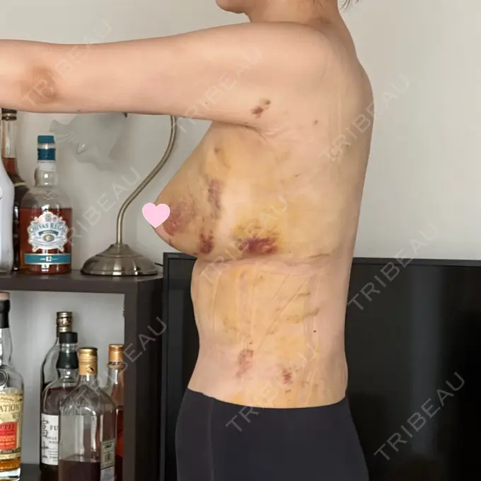 脂肪吸引（お腹） / 豊胸（脂肪注入） / 脂肪吸引（腰） / 脂肪吸引（背中） WOM CLINIC GINZA （ワム クリニック ギンザ） DAY 7 メイン用