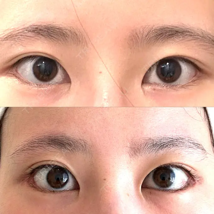 タレ目形成・グラマラスライン（切開） 銀座マイアミ美容外科 DAY 36 メイン用