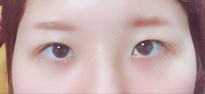 眼瞼下垂（切開） みずほクリニック DAY 61 メイン用