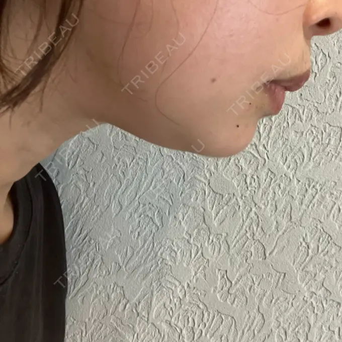 ハイフ（顔） A CLINIC（エークリニック） 仙台院 DAY 15 メイン用