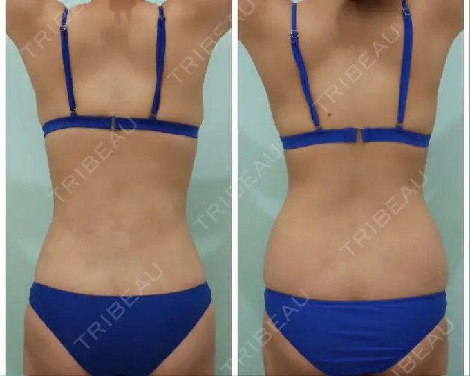 脂肪吸引（お腹） / 脂肪吸引（腰） / 脂肪吸引（背中） WOM CLINIC GINZA （ワム クリニック ギンザ） DAY 38 メイン用