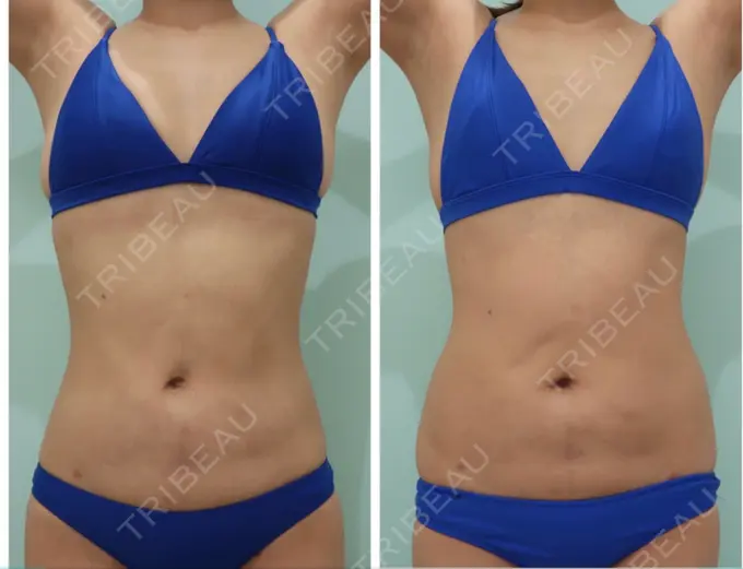 脂肪吸引（お腹） / 脂肪吸引（腰） / 脂肪吸引（背中） WOM CLINIC GINZA （ワム クリニック ギンザ） DAY 38 メイン用