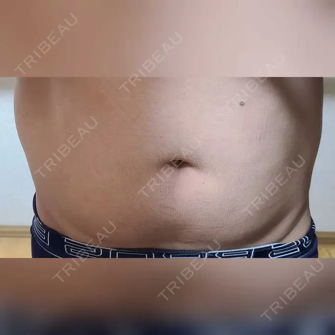 脂肪冷却（お腹） みずほクリニック DAY 3 メイン用