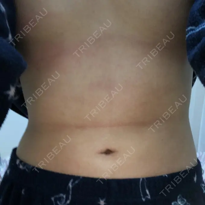 脂肪吸引（お腹） ドクターフィット（Dr.fit）クリニック DAY 25 メイン用