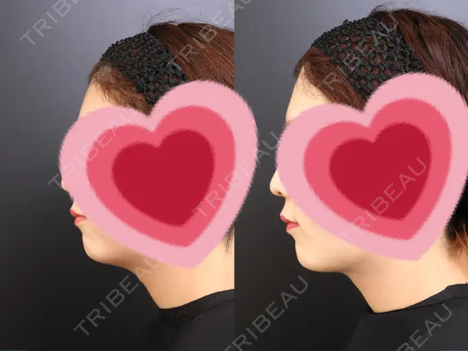 脂肪吸引（顔） / ジョールファット除去 / ボトックス（エラ・小顔） Otus Clinic 【オータスクリニック】 DAY 101 メイン用