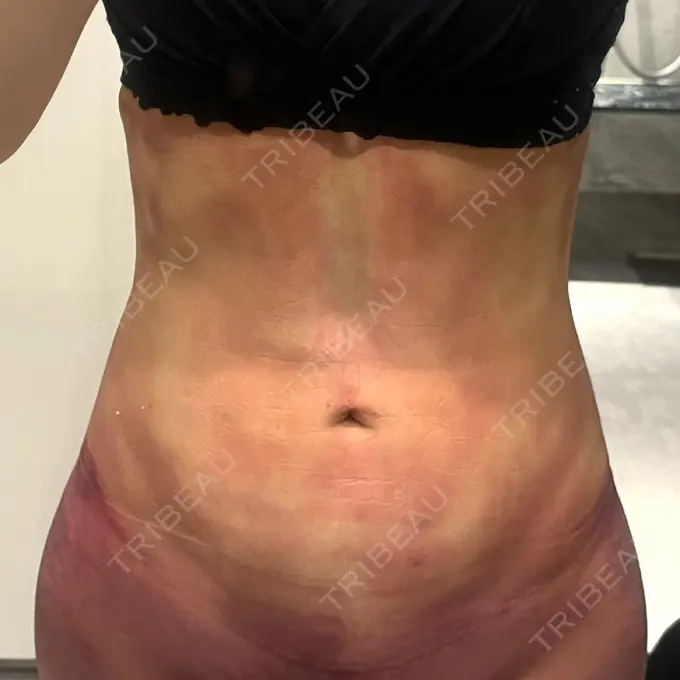 脂肪吸引（お腹） / 脂肪吸引（腰） WOM CLINIC GINZA （ワム クリニック ギンザ） DAY 2 メイン用