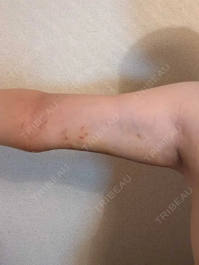 脂肪吸引（二の腕） 石倉クリニック 水戸院 DAY 5 メイン用