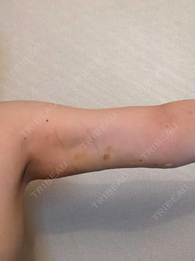 脂肪吸引（二の腕） 石倉クリニック 水戸院 DAY 5 メイン用