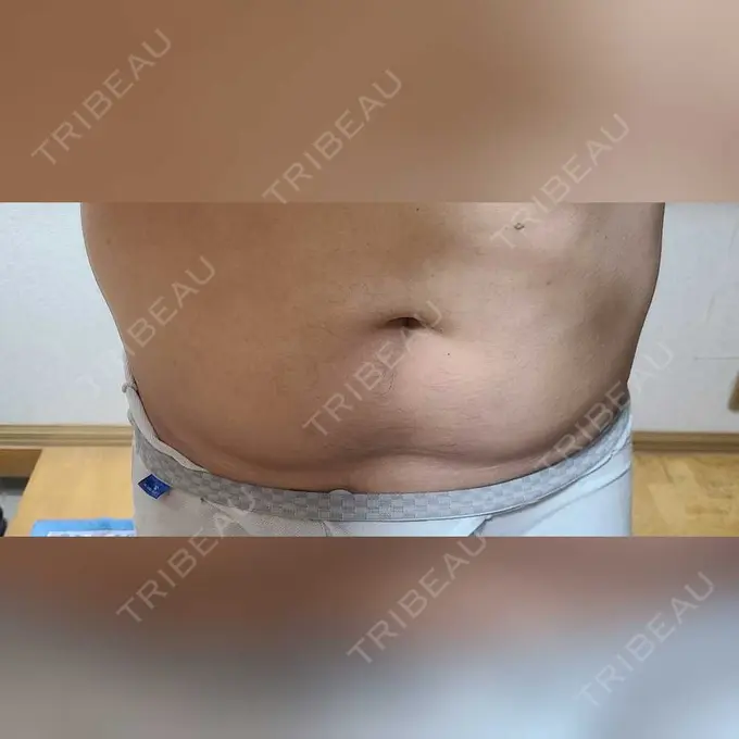 脂肪冷却（お腹） みずほクリニック DAY 4 メイン用