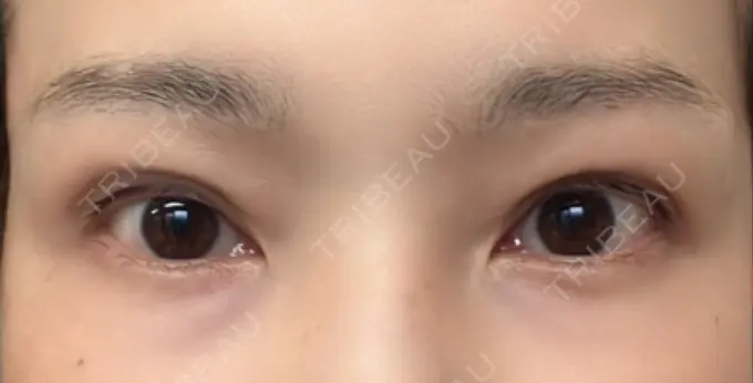 二重埋没 / 目元修正 オーキッド美容クリニック東京御徒町 DAY 41 メイン用