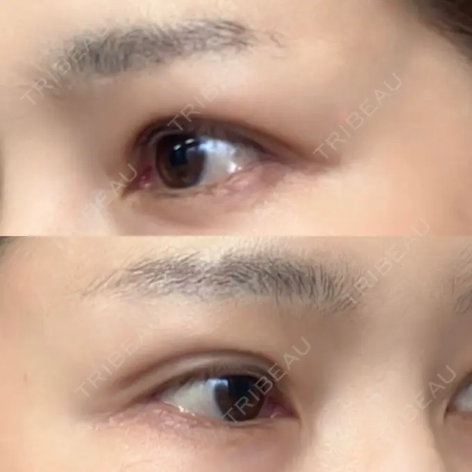 二重埋没 / 目元修正 オーキッド美容クリニック東京御徒町 DAY 41 メイン用