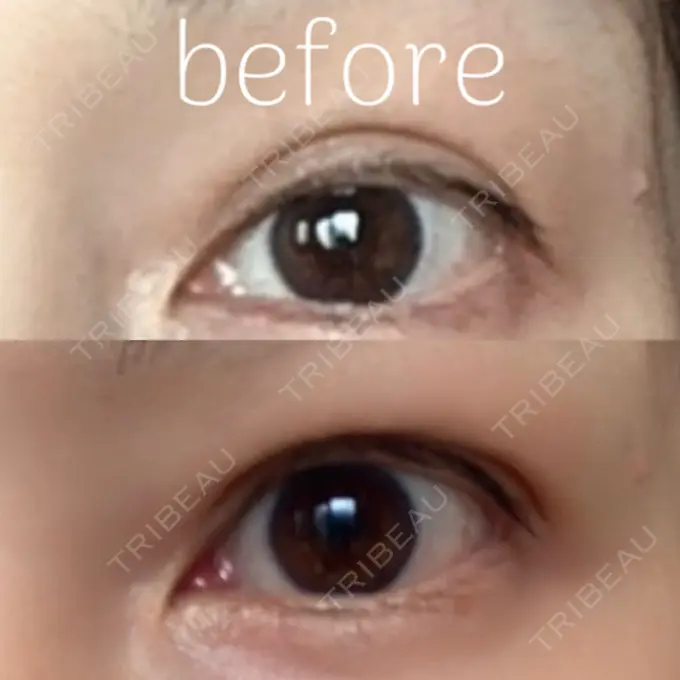 二重埋没 / 目元修正 オーキッド美容クリニック東京御徒町 DAY 41 メイン用