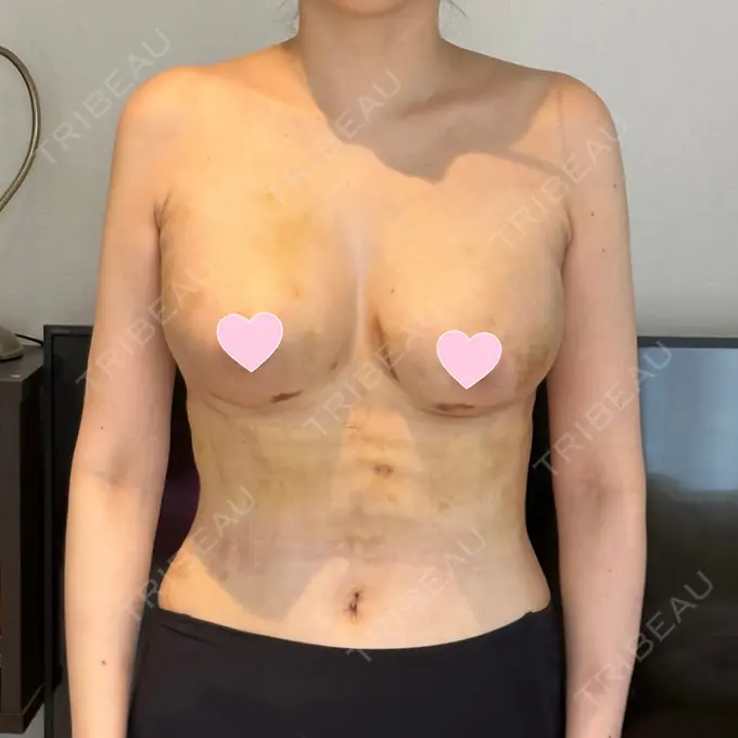 脂肪吸引（お腹） / 豊胸（脂肪注入） / 脂肪吸引（腰） / 脂肪吸引（背中） WOM CLINIC GINZA （ワム クリニック ギンザ） DAY 10 メイン用