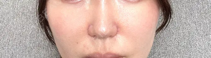 小鼻縮小（切開） / 鼻翼挙上 東京美容医療クリニック 池袋院 DAY 31 メイン用