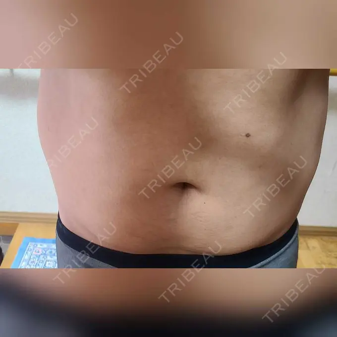 脂肪冷却（お腹） みずほクリニック DAY 5 メイン用