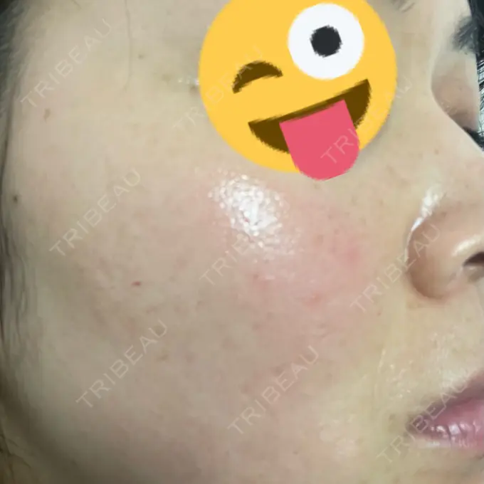 ピコレーザートーニング（美白・肝斑） アモーレクリニック 名古屋院 DAY 19 メイン用