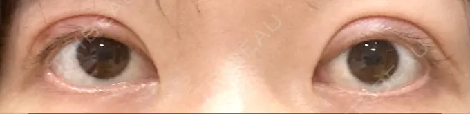 二重切開 / 目元修正 心斎橋コムロ美容外科クリニック DAY 204 メイン用