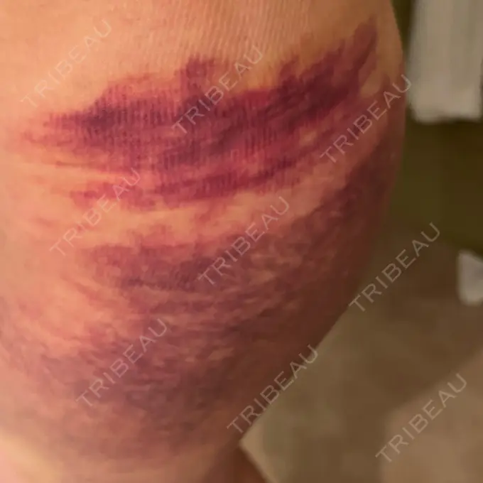 脂肪吸引（お腹） / 脂肪吸引（腰） WOM CLINIC GINZA （ワム クリニック ギンザ） DAY 4 メイン用