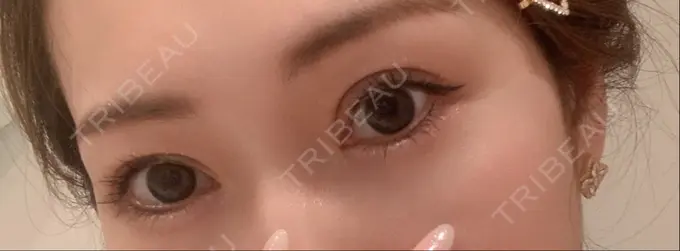 眼瞼下垂（切開） yuzawa clinic DAY 34 メイン用