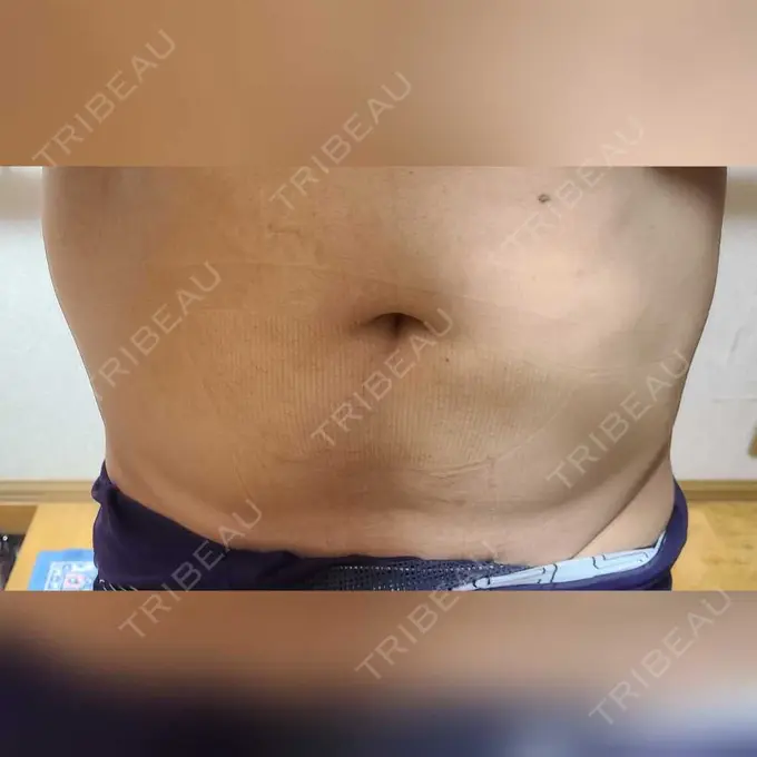 脂肪冷却（お腹） みずほクリニック DAY 6 メイン用