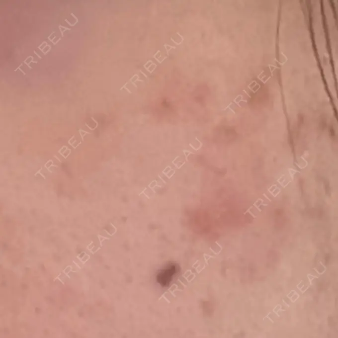 ピコスポット LOUIS CLINIC 二子玉川院【ルイクリニック】 DAY 20 メイン用