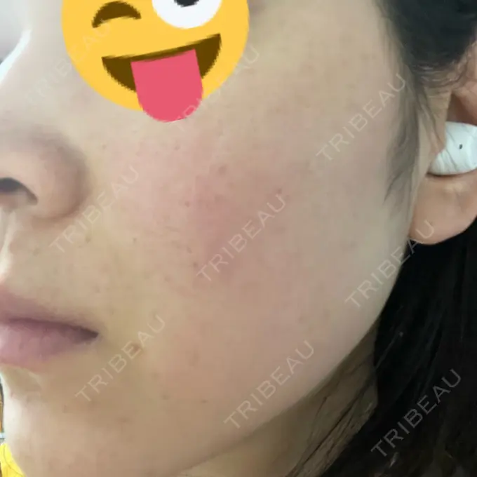 ピコレーザートーニング（美白・肝斑） アモーレクリニック 名古屋院 DAY 21 メイン用