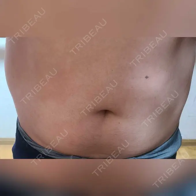 脂肪冷却（お腹） みずほクリニック DAY 7 メイン用